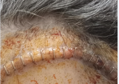 RMT Metalhead Post-opxperience 27 Staplestaples to raassemble my scalp Beter not go though a metal detector or sztrong magnetic field At the momeent!